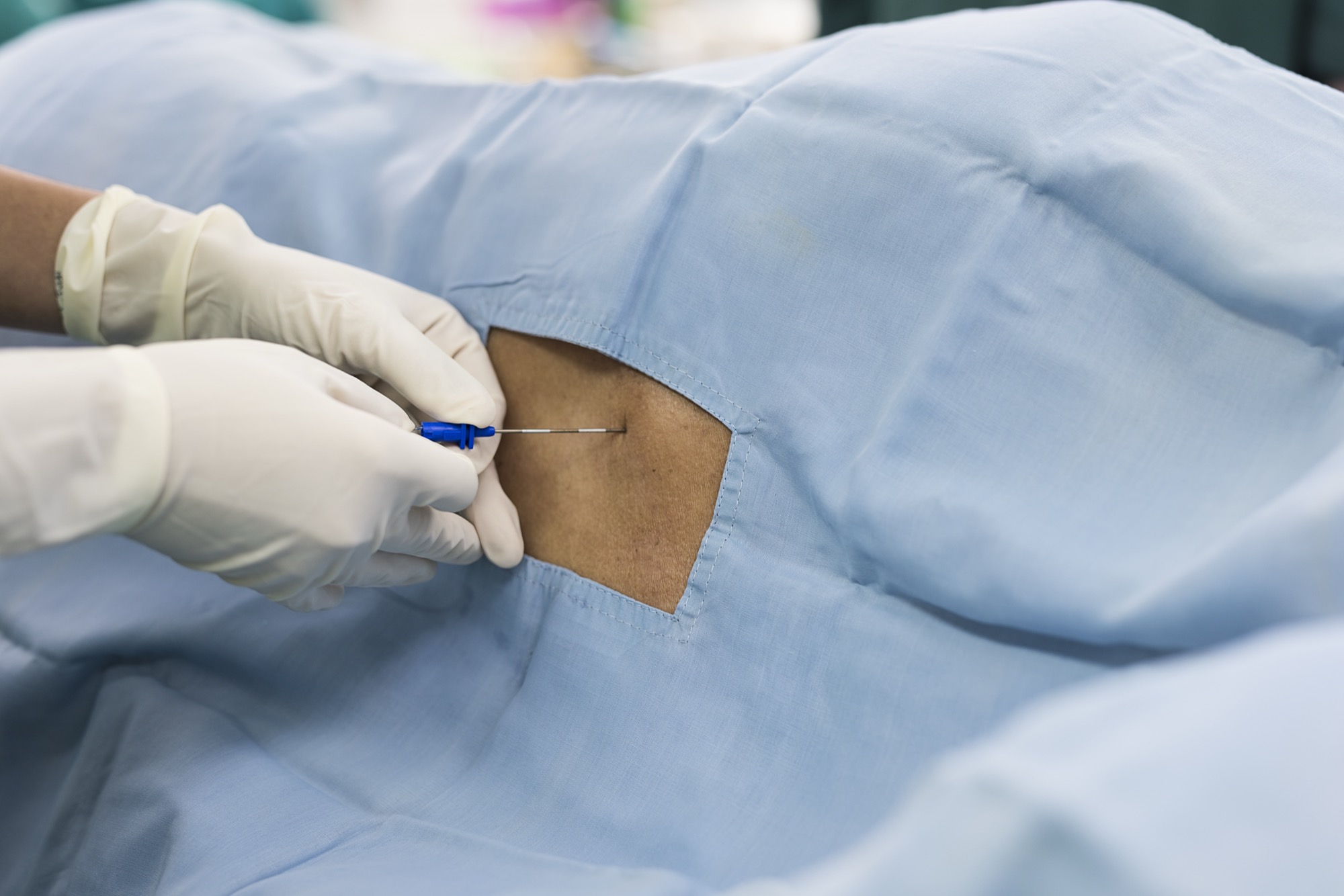 Gloved hands placing a needle through a sterile drape during an image-guided spinal injection